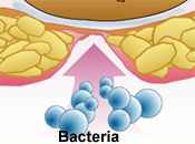 Ulcers